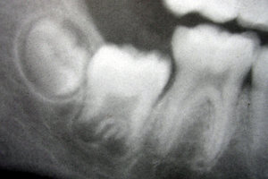 Radiograph of lower right (from left to right) third, second, and first molars in different stages of development.
